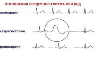 ВСД, развивающаяся по кардиальному типу