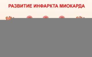 Локализация инфаркта миокарда и его последствия