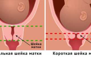 Укороченная шейка матки при беременности — что значит и чем опасна патология