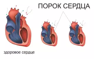 Терапия порока сердца: методика и особенности