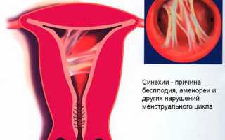 Лечение синехий в полости матки