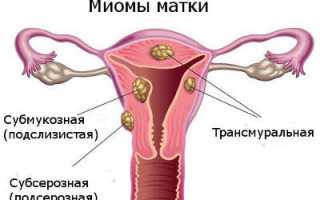 Миома матки: причины, симптомы и лечение