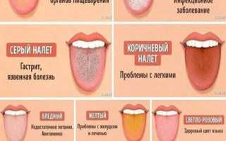 Коричневый налет на языке у ребенка, в каком случае обратиться к врачу