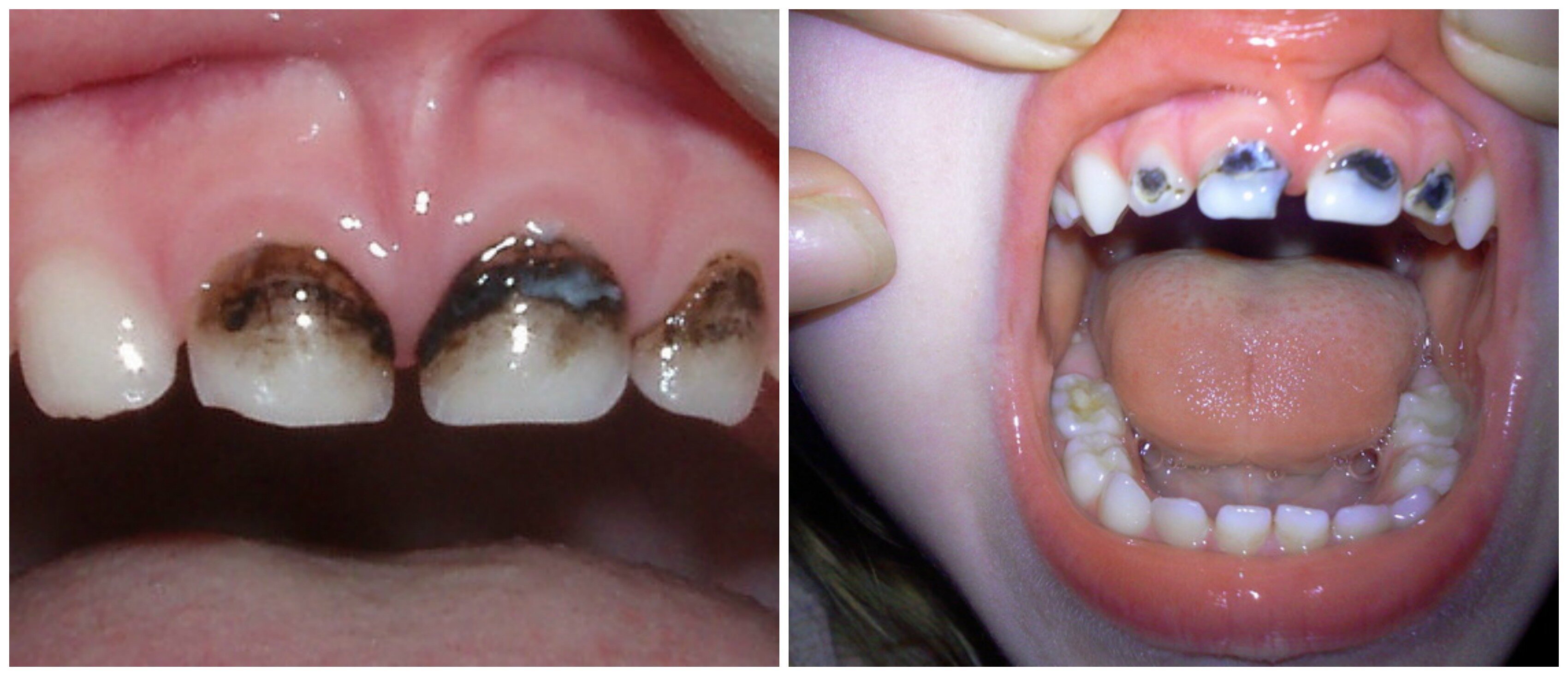 Серебрение молочных зубов Томск Матросова Лечение пародонтита Томск Малиновая